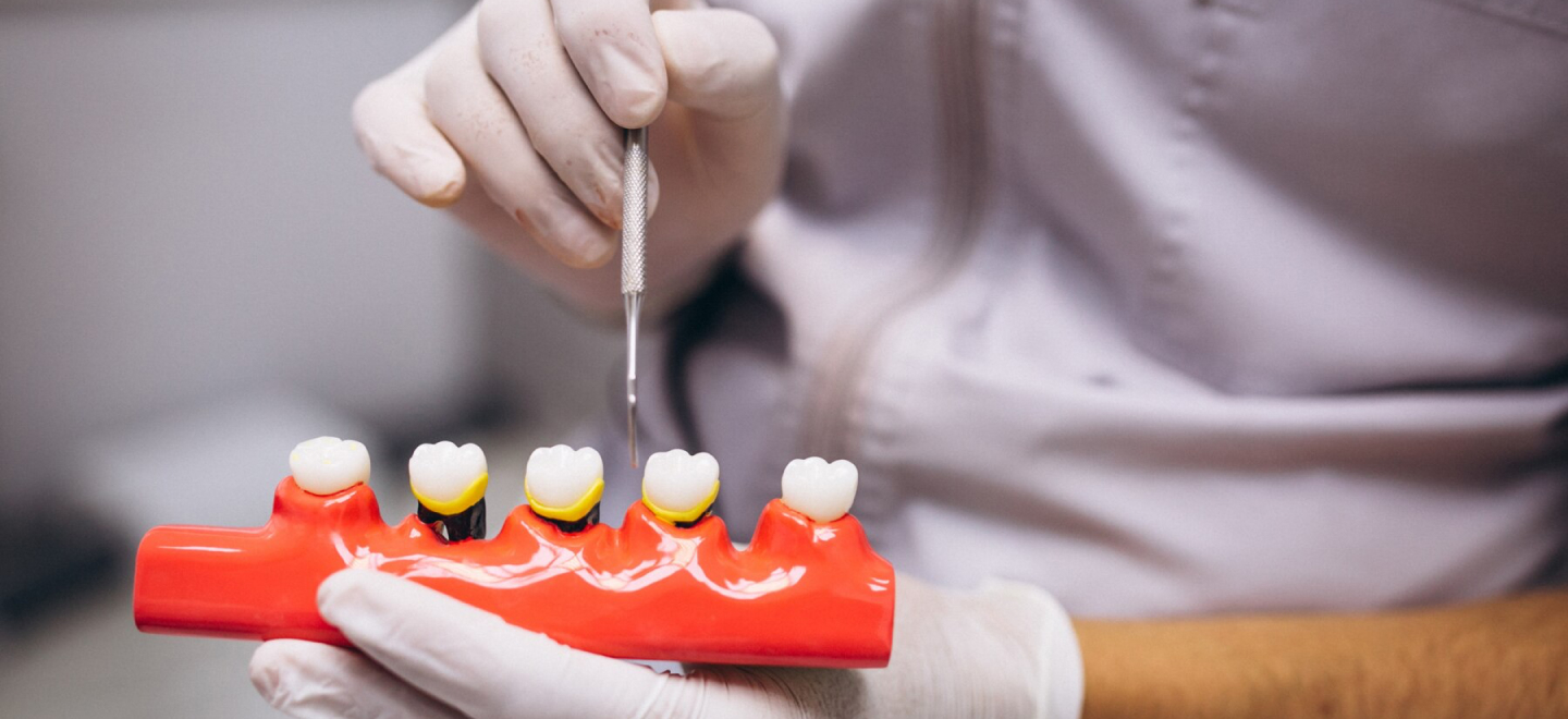 Dental Crowns Warsaw