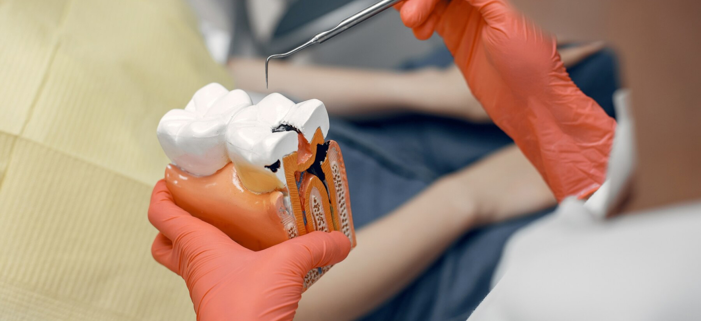 Root Canal Treatment Warsaw